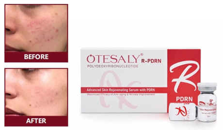 高端沙龙的秘密武器 OTESALY R-PDRN 如何提高客户流量和声誉 .jpg