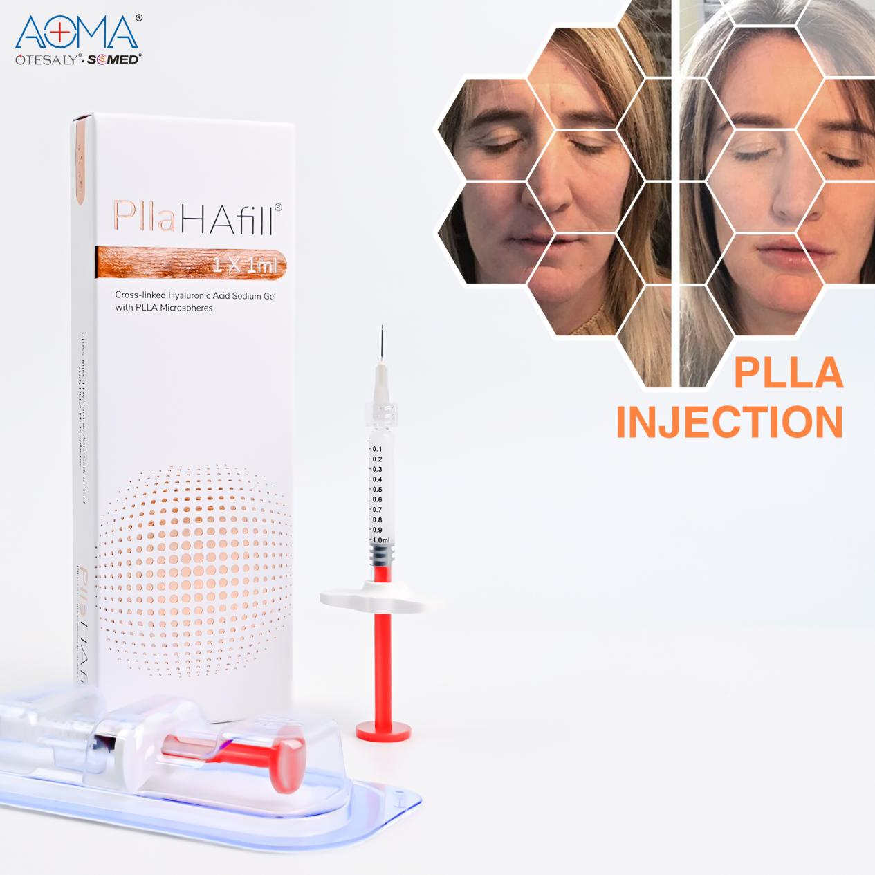 Sculptra PLLA 填充劑：有效面部輪廓的關鍵