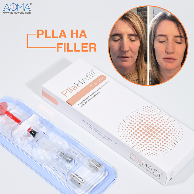 Pain free 1ml pllahafiller PLLA injection nasolabial nga dagiti folds .