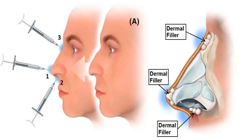 非手术隆鼻解释透明质酸填充剂与其他选择？