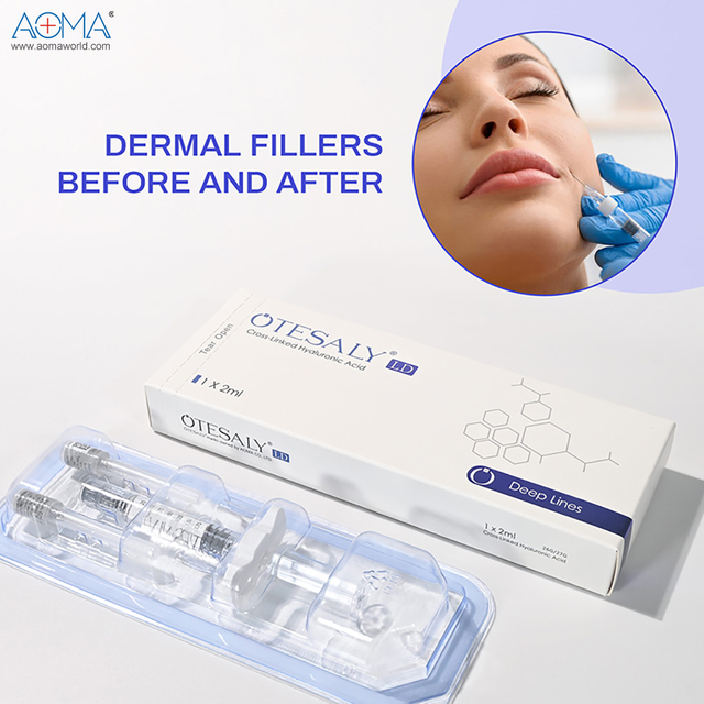 可注射 2 毫升利多卡因 利多卡因 鼻樑橋